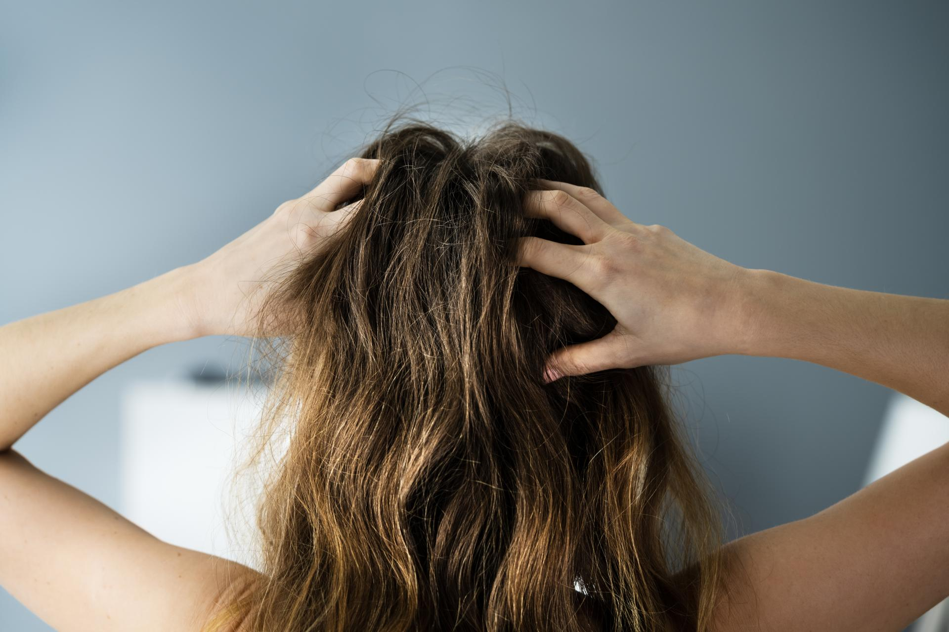 Winning Against Chronic Scalp Dermatitis